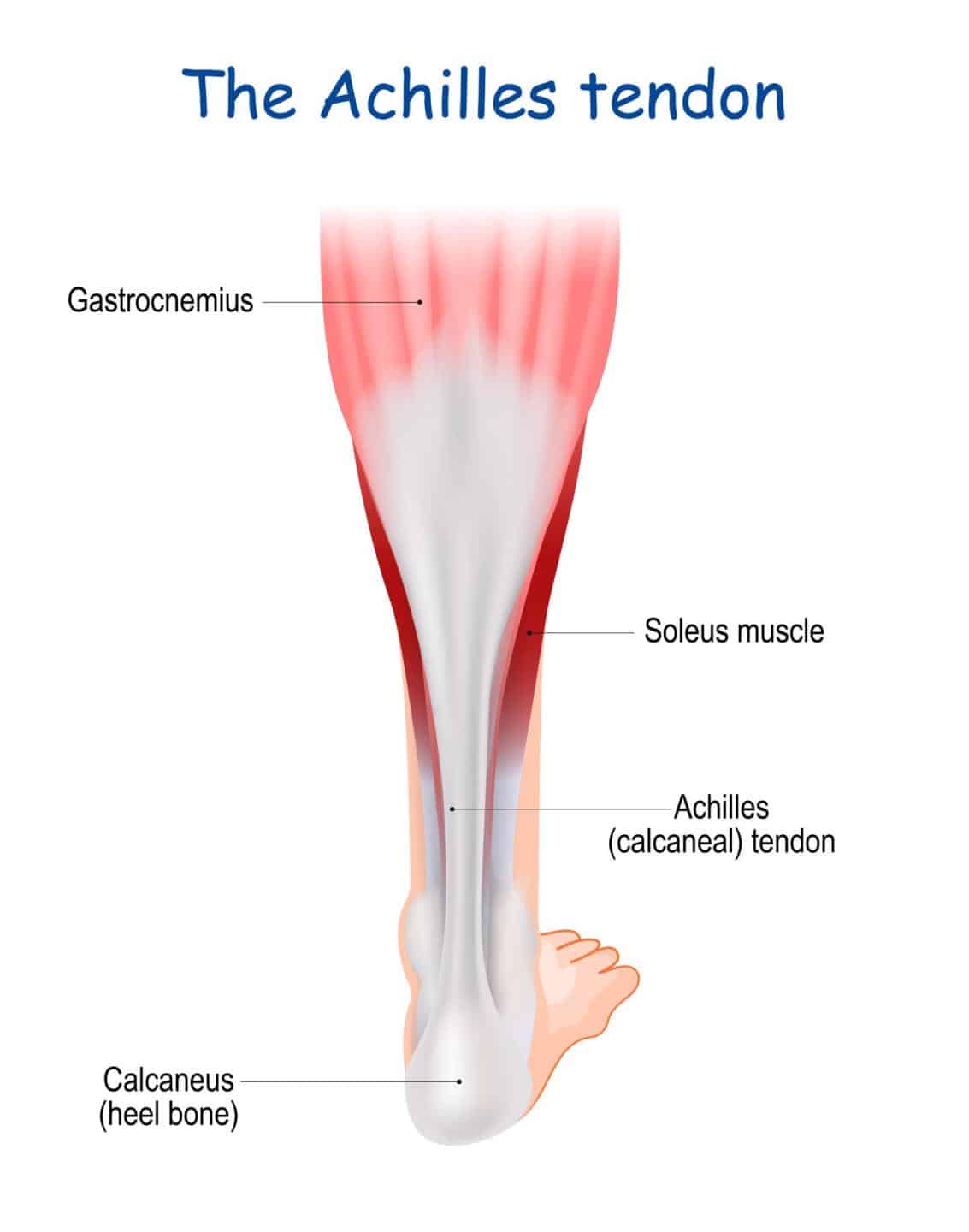 Anatomical diagram of the gastrocnemius muscle for ultrasound-guided Achilles tendinopathy