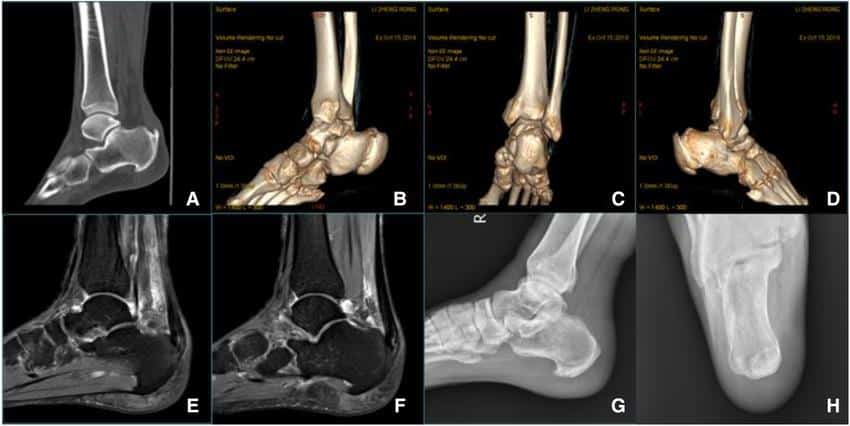 Diagnostic imaging of calcific tendonitis - CT scan, MRI and X-ray