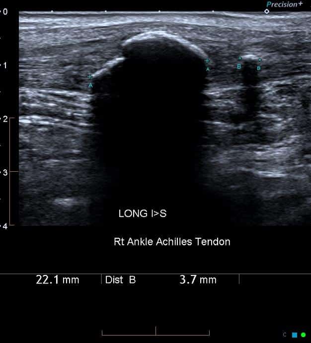Ultrasound of the Achilles tendon