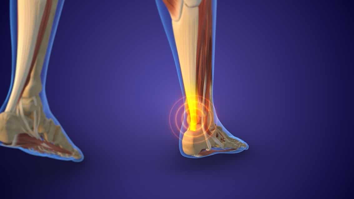 Patient diagnosed with ultrasound-guided Achilles tendinopathy