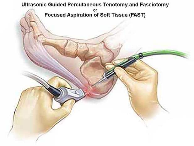 Ultrasound-guided percutaneous tenotomy - illustration