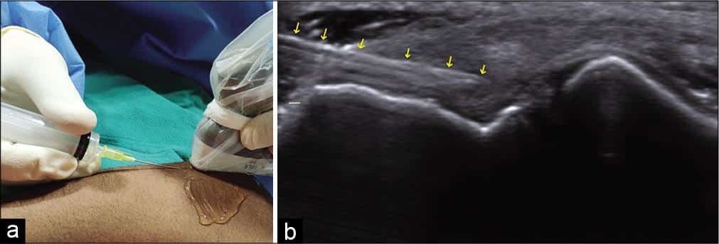 Ultrasound-guided percutaneous procedure