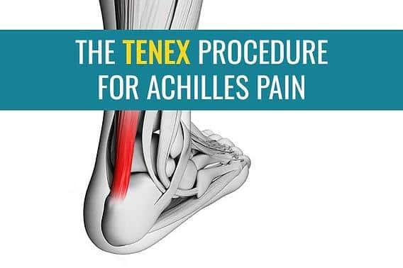 Tratamiento sin cirugía de la tendinitis calcificante del tendón de Aquiles con Tenex Health (TenJet / Tenex)