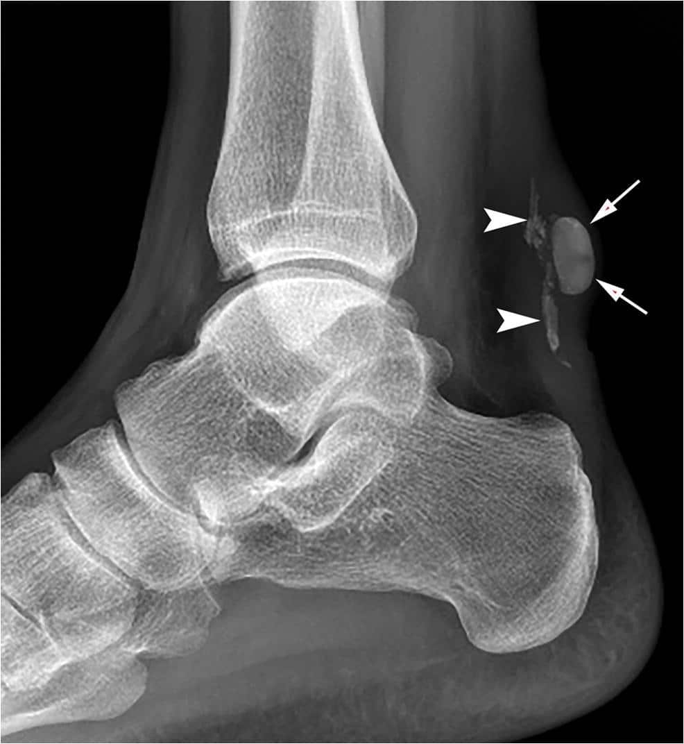 X-ray showing calcified deposits in the Achilles tendon